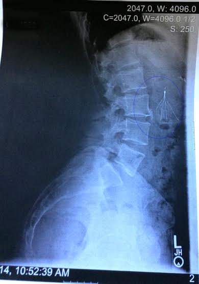 An x-ray of Brenneman's spine, with injuries sustained from the plane crash and beatings from Isgitt's hired men. (Photo courtesy of Jill Brenneman and Amanda Brooks)